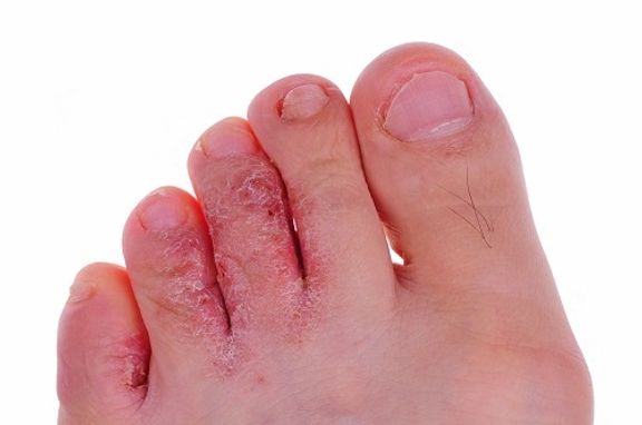 What Athlete's Foot | Duly Health and Care - DuPage Medical Group